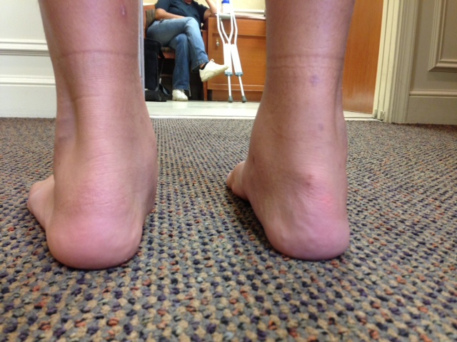 Flatfeet Pictures - Podiatry, Orthopedics, & Physical Therapy